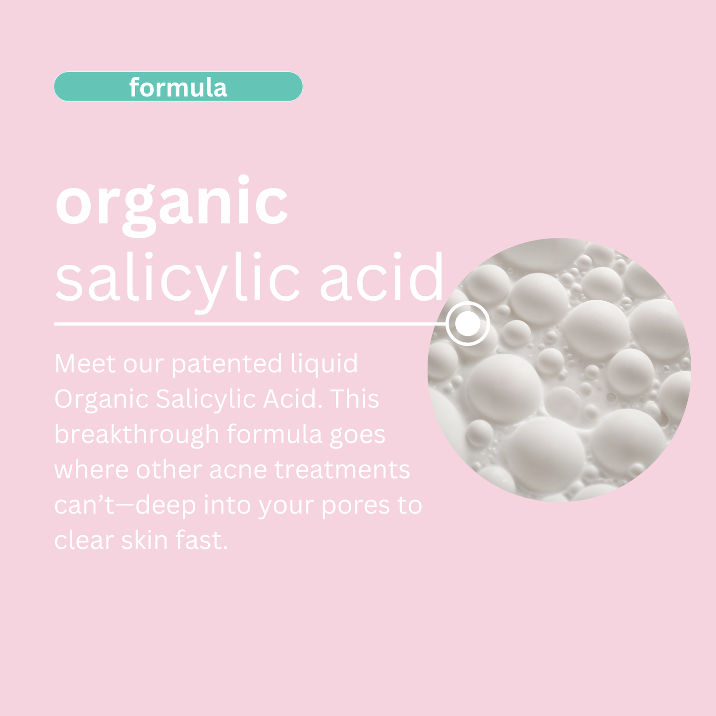 Award Winning〡1% Salicylic Acid Acne Day Cream