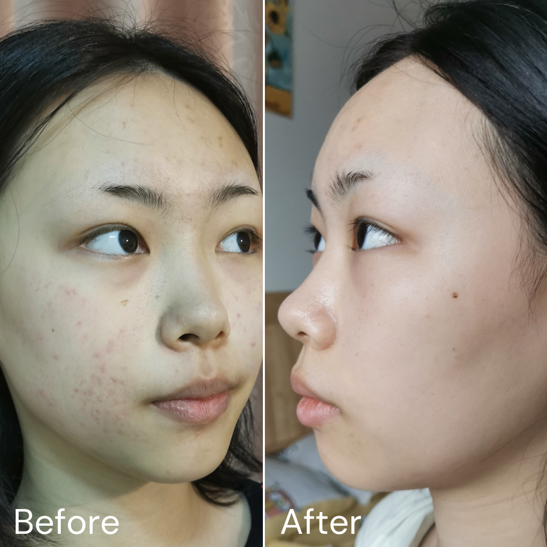 Organic Salicylic Acid〡Acne Treatment Set