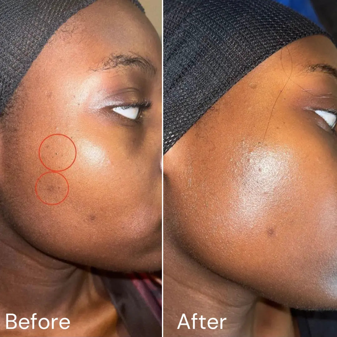 Acne Day Cream Hollywoodskin