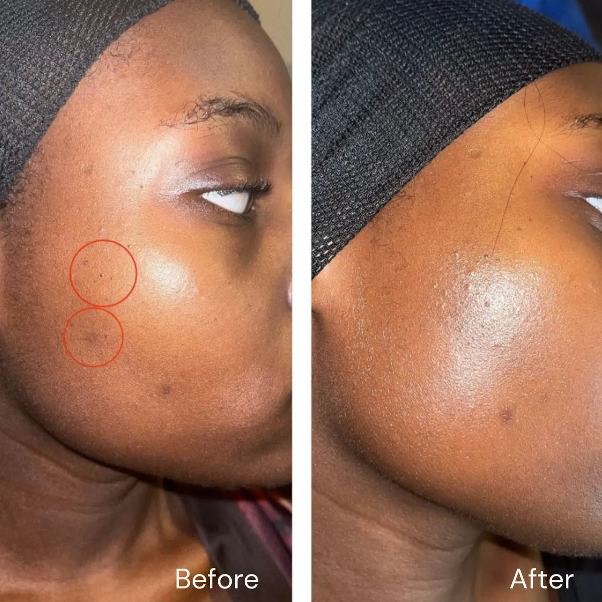 Acne Treatment Set Hollywoodskin