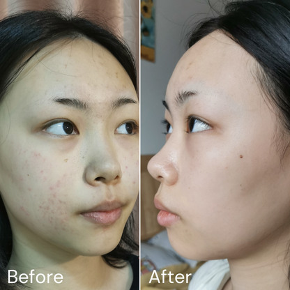 2% Salicylic Acid〡Acne Night Cream