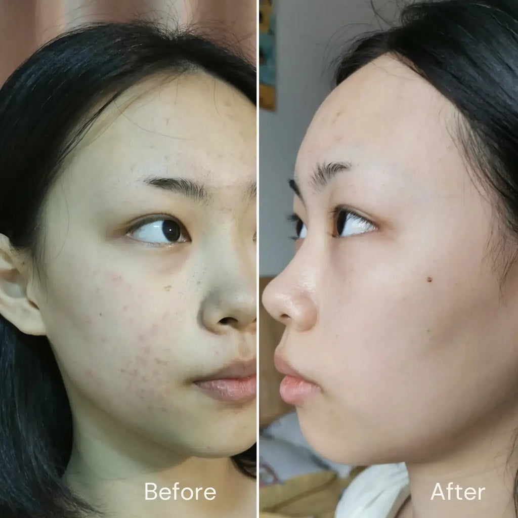 Acne Treatment Set Hollywoodskin