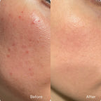 Acne Night Cream texture and application
Before and after overnight acne treatment results

