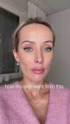 Crème de jour anti-acné